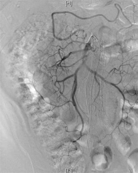 Superior Mesenteric Artery Angiography Showing The Presence Of Marginal