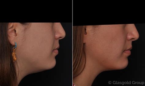 Neck Liposuction Before And After Princeton Nj