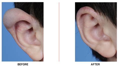 Ear Reconstruction Gallery