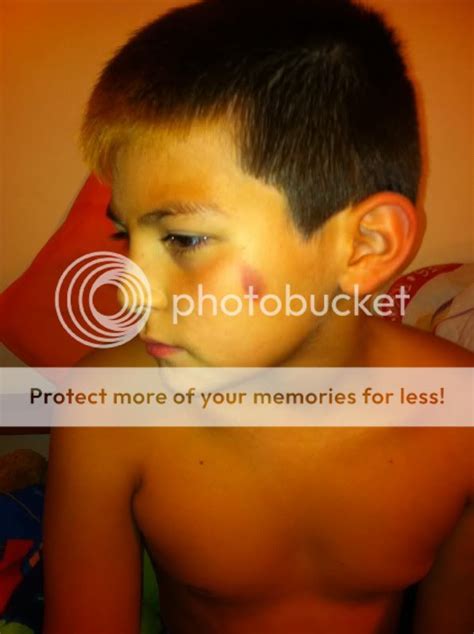Reoccurring Bruises On Kids Pic Included Babycenter