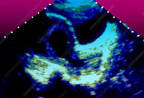 Miscarriage Ultrasound Scan Stock Image P6800574 Science Photo