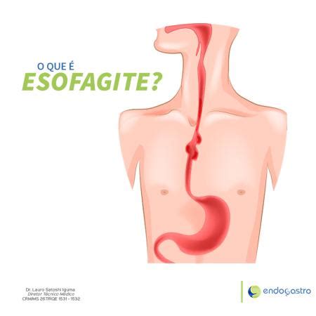 O que é Esofagite Endogastro Endoscopia Digestiva