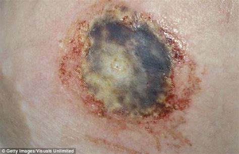 Can buruli ulcer heal by itself? African flesh-eating 'Buruli ulcer' is spreading through ...