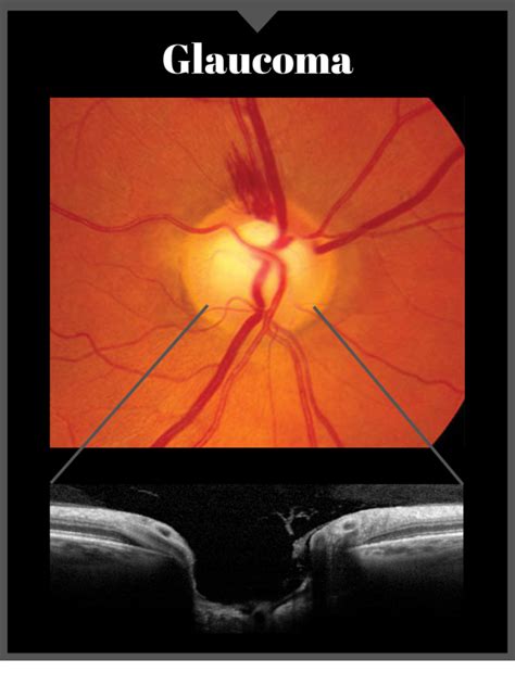 Digital Retinal Imaging Greenfield Optometry
