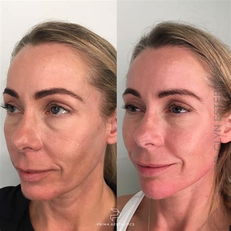 Full Face Rejuvenation Treatment In Chester Dr Glyn Estebanez