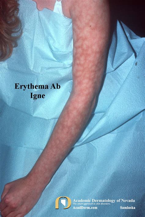 Erythema Ab Igne Stop Using The Heating Pad Academic Dermatology