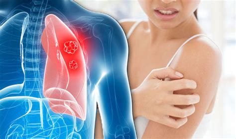What causes stage iv lung cancer? Lung cancer symptoms: Tumour signs include skin lumps and ...
