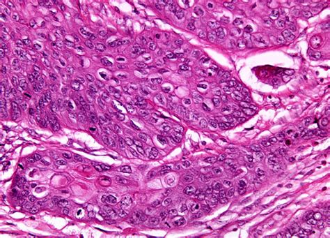 Esophageal Carcinoma At 20x Magnification Nikons Microscopyu