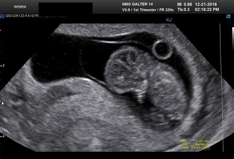 This is why an early pregnancy dating scan, rather than one done in the later stages of pregnancy, is considered more accurate when assessing the expected expect with every day which passes, the embryo becomes bigger and more advanced in its development. 9 weeks pregnant dating scan. week pregnancy dating scan ...