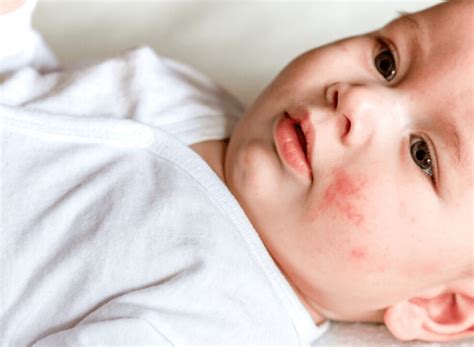 Top 3 Most Effective Ways To Get Rid Of Baby Acne Heliotherapy
