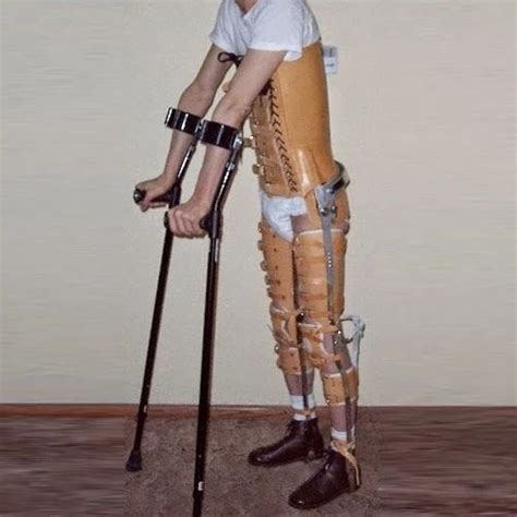 Polio Calipers Kafohkafo Spinal Cord Injury Leg Braces Manufacturer