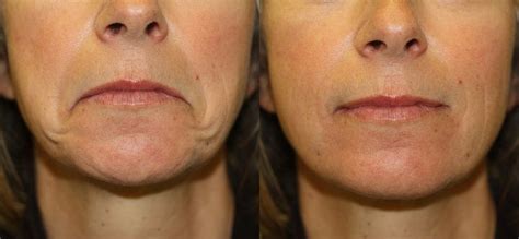 Botox Before And After Mouth Before And After