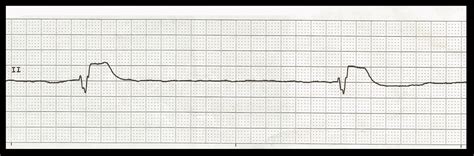 Float Nurse: Practice EKG Strips 396