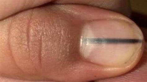 Nail Salon Visit Leads To Cancer Diagnosis For Woman With Black Line On Fingernail Daily Telegraph