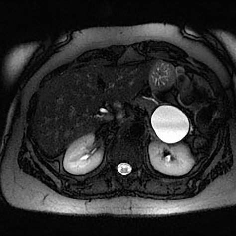 Carcinoma Of The Head Of The Pancreas Pancreas Case Studies Ctisus