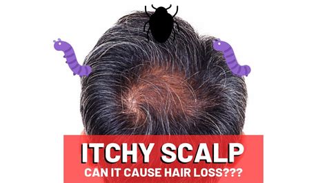Itchy Scalp And Hair Loss 5 Big Causes Youtube