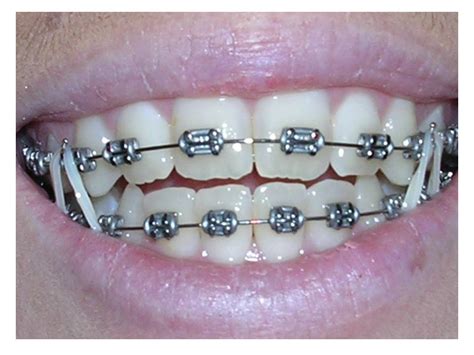 Jenis gigi yang tak boleh pakai braces. CT: HUKUM TEETH BRACES @ PENDAKAP GIGI