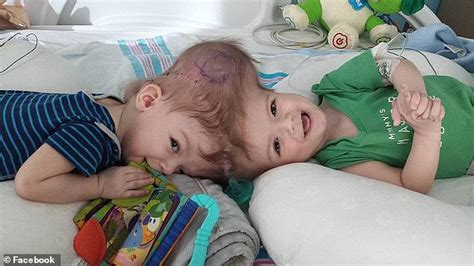World Renowned Nyc Pediatric Neurosurgeon 73 Who Separated Conjoined