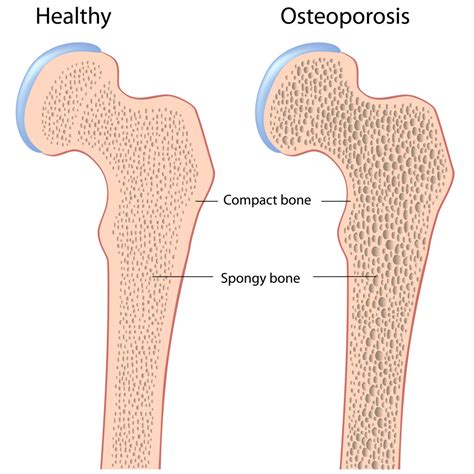 Overview Of Three Common Bone Disorders Osteoarthritis Rheumatoid