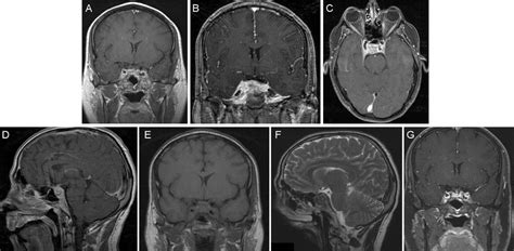 Inflammatory Pseudotumor Of The Cavernous Sinus And Skull Base