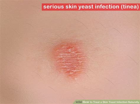 How To Treat A Skin Yeast Infection Naturally How To Do