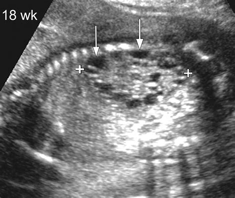 Detection Of Fetal Structural Abnormalities With Us During Early