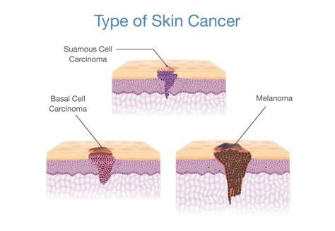 Major Types Of Skin Cancer
