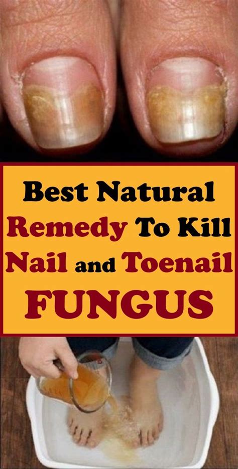 Review Of Best Natural Treatment For Toenail Fungal Infection 2022