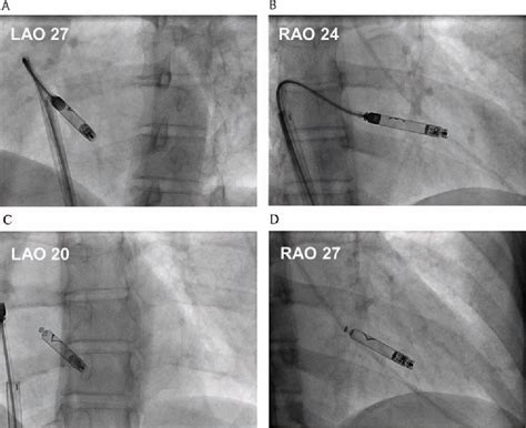 Figure 1 From Use Of The Leadless Pacemaker To Provide Empiric Pacing