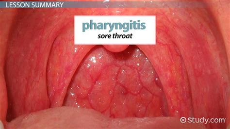 What Is Pharyngitis Definition Causes Symptoms And Treatment Video