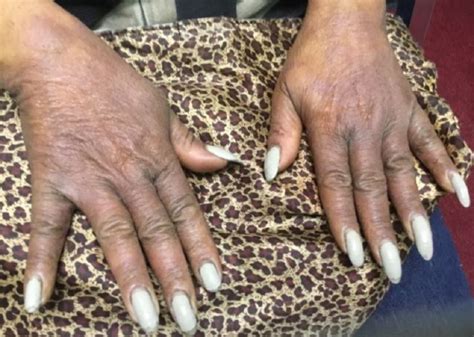Dermdx Pruritic Rash On The Hands Dermatology Advisor