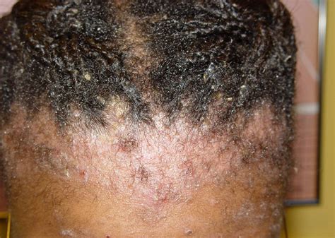 The dermatitis presents as scaly, sometimes oily, inflamed skin that can be itchy or even painful to touch. It's More Than Just Dandruff - MDhairmixtress.com