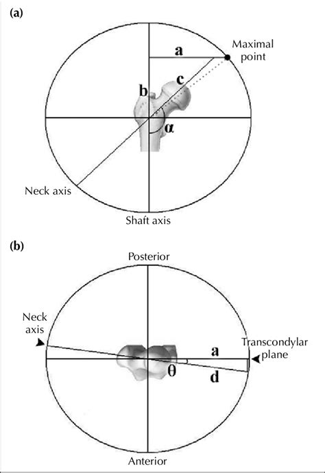 A In The Anteroposterior View Of The Femur The Neck Shaft Angle α