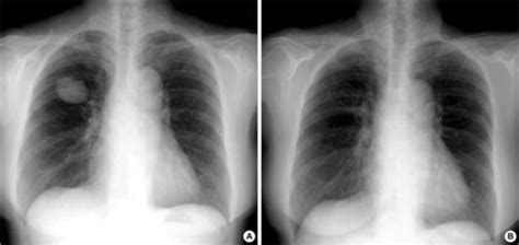 Chest Radiography Shows A Very Large Cyst In Right Uppe Open I