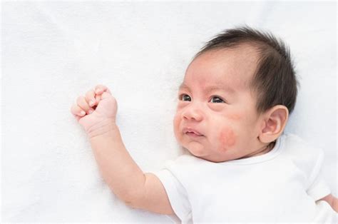 Pityriasis alba is a common skin disorder in children (90%) and young adults. Pityriasis Alba