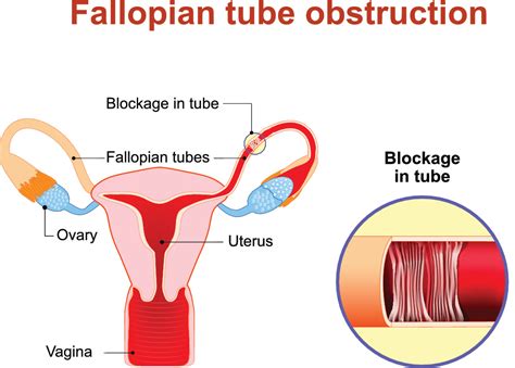 Blocked Or Damaged Fallopian Tubes Causes And Treatment The Pulse