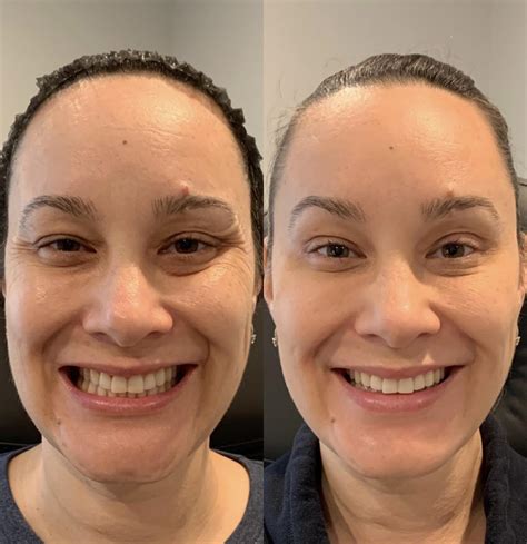 Dermal Fillers Before And After Pictures Case 65 Sacramento Ca Destination Aesthetics