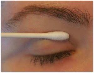 This video demonstrates an upper eyelid blepharoplasty using the monopolar cautery. why are my eyelids dry - pictures, photos
