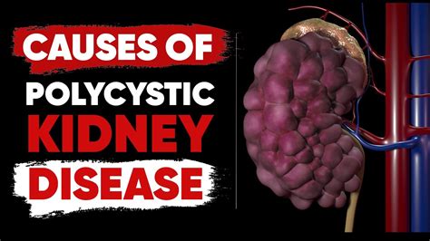 Causes Of Polycystic Kidney Disease Youtube