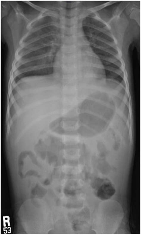Chest And Abdomen X Ray Shows Showed Right Sided Mild Pleural Effusion