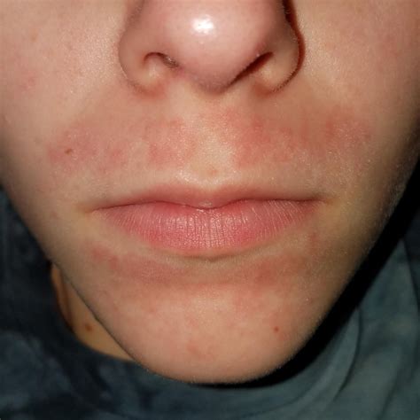 Ive Been Struggling With This Reacurring Patch Of Acne That Started