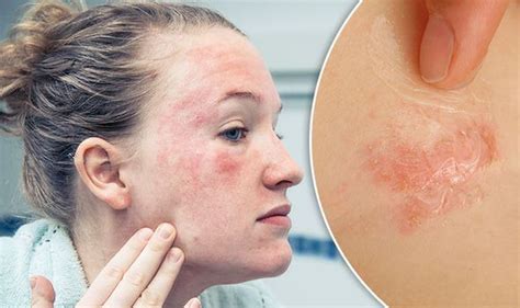 How To Get Rid Of Eczema On The Face Dry Skin On Face Get Rid Of