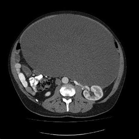 An Unusual Cause Of Gross Abdominal Distension In A 59 Year Old Man