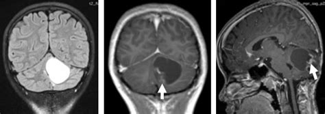 Pilocytic Astrocytoma Radiology Cases