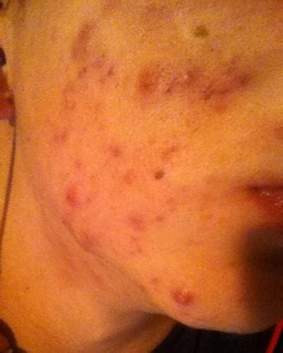 Stubborn Jawline Acne Spread To Cheeks General Acne Discussion