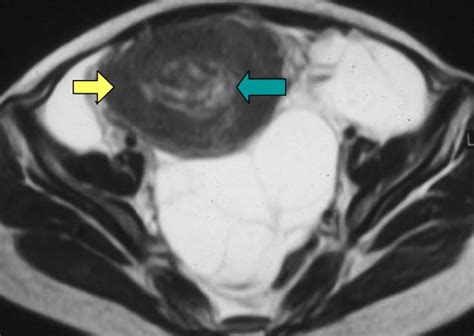 Bilateral Theca Lutein Cysts Associated With Hydatidiform Mole Mr