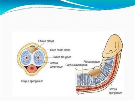 Peyronies Disease