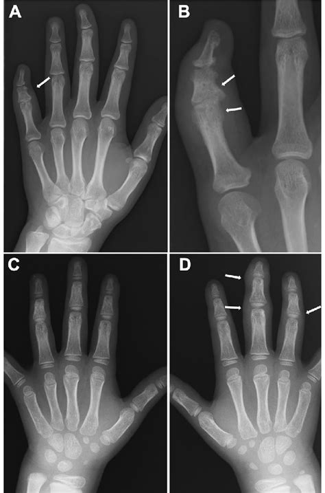 Two Cases With Sausage Fingers With Or Without Dactylitis A B A