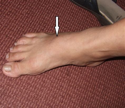 Painful Lump Over The Foot It Could Be Bony Spurs Dr Hc Chang