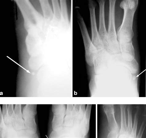 The Incidence Of Accessory Navicular Bone Types In Turkish Subjects